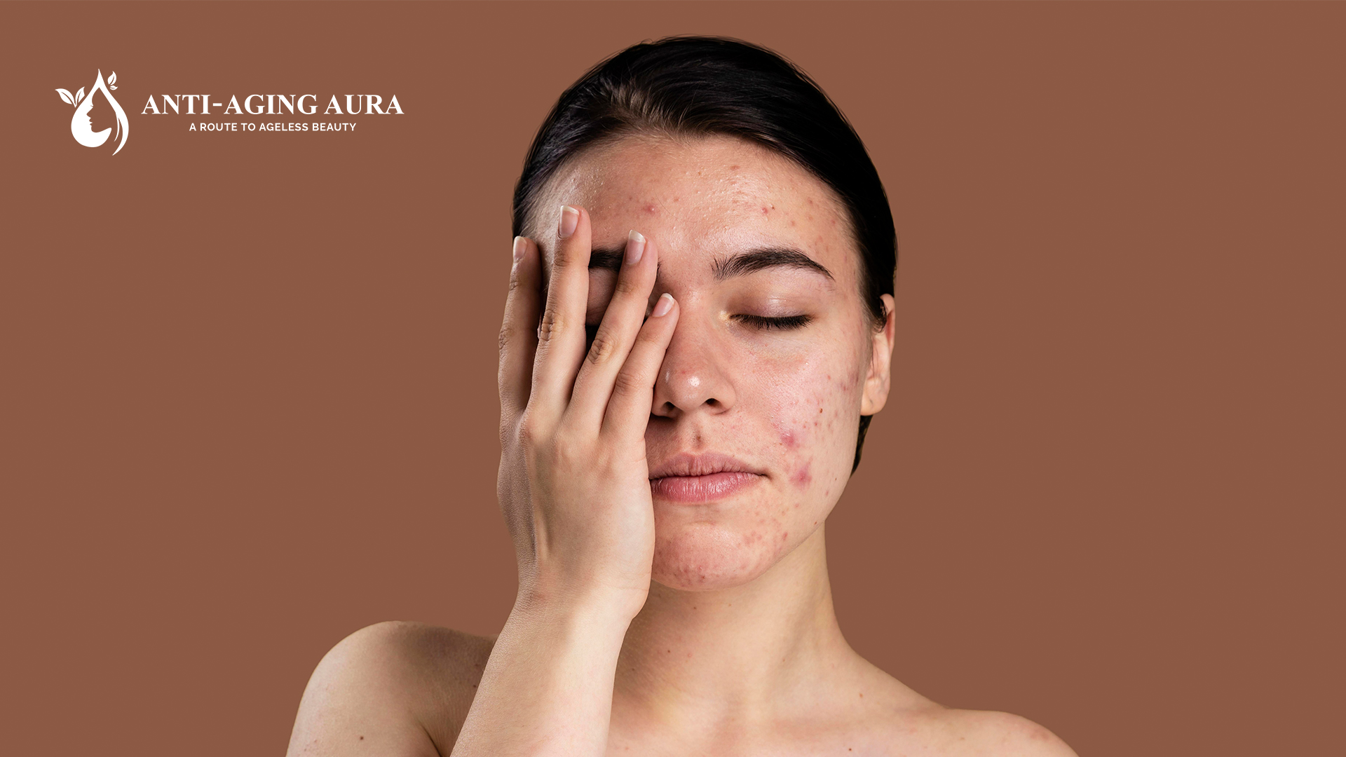 Can retinol cause acne?